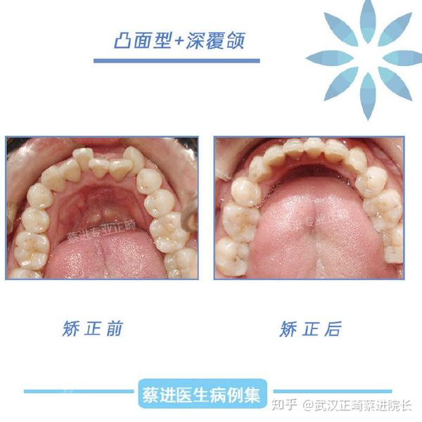 深覆颌 zhuanlan.zhihu.com