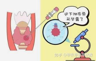 甲状腺穿刺活检的危害?会不会有什么副作用?