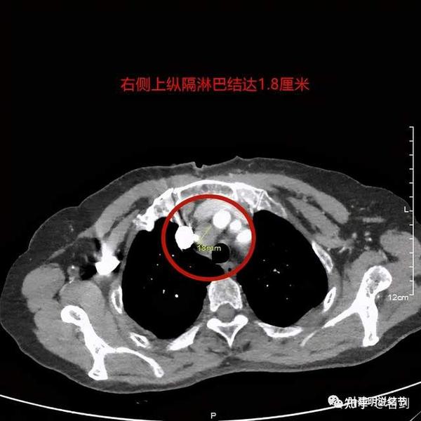 右上纵隔淋巴结肿大,达1.8厘米