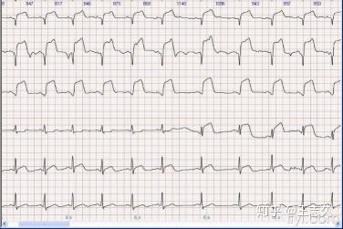 所以我们不用担心得了急性心梗而心电图不符合理赔条件.