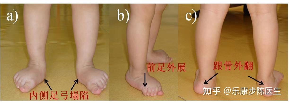 女童只因早学步两个月却花几年时间治疗足外翻早学步的危害足外翻又该