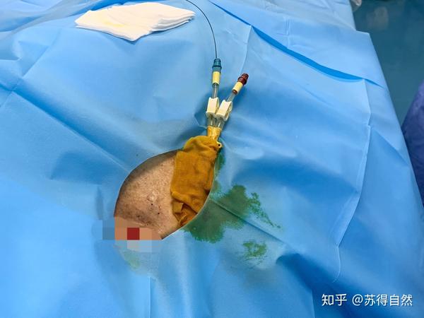 病史:患者唐某,规律血液透析5年余,反复导管感染有1年余,导管cuff