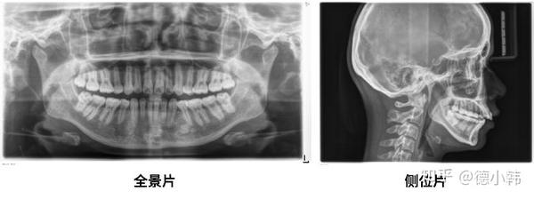 x光片ct小牙片矫正前究竟要拍哪种