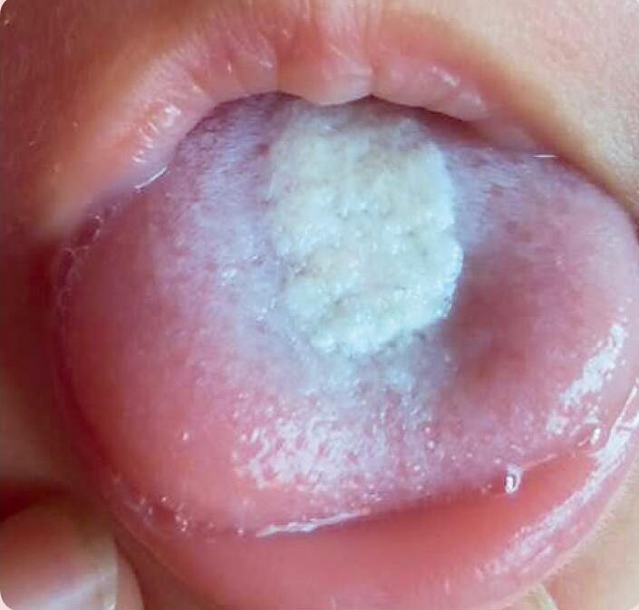 舌苔中间后:积食这是一个典型的婴儿积食舌象,婴儿积食会影响胃肠功能