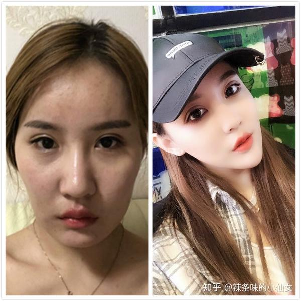 北京磨骨,下颌骨手术效果真的好吗?哪些医院医生较好