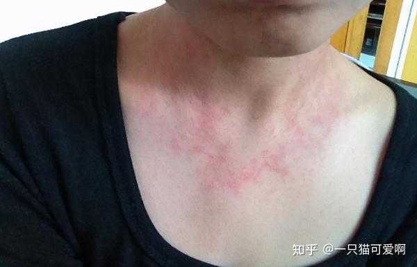 hpv病毒感染引起的扁平疣,一开始是呈红色小点,或是肉条状,多是发生