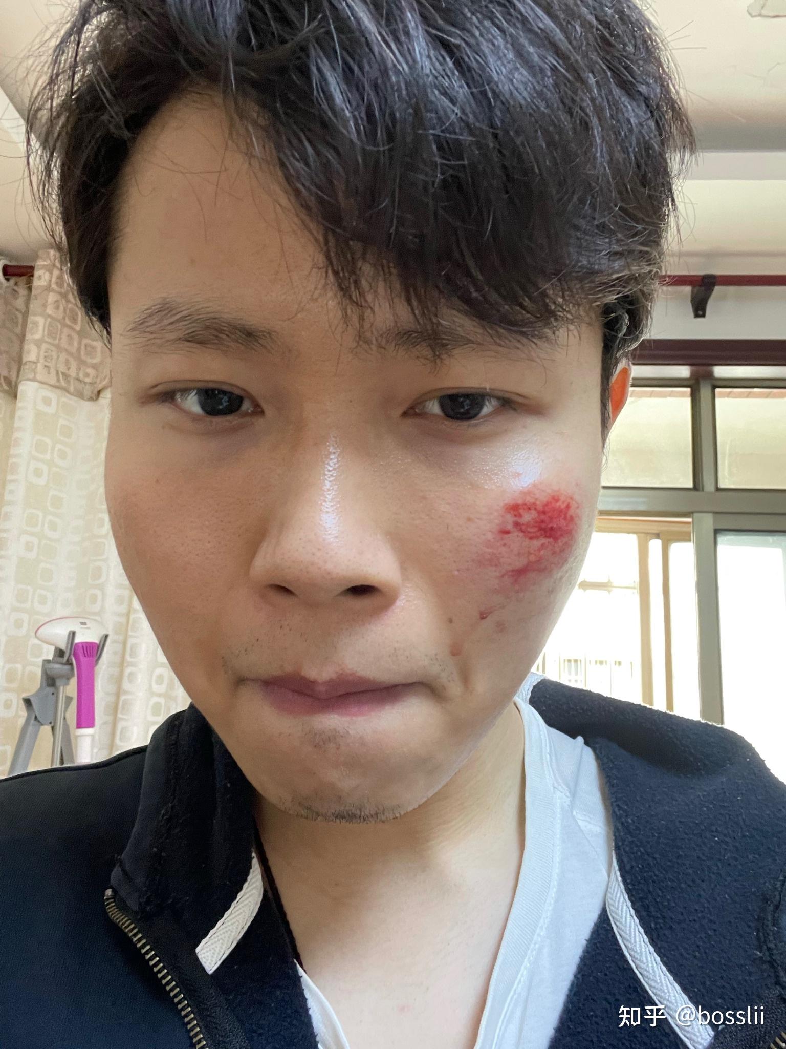脸部擦伤如图请问如何恢复