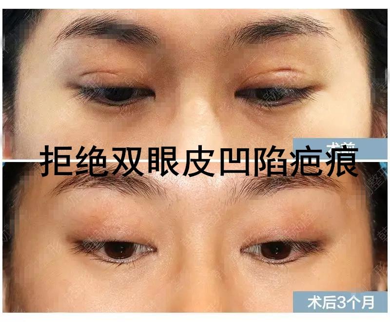 如何避免双眼皮的闭眼凹陷疤痕?