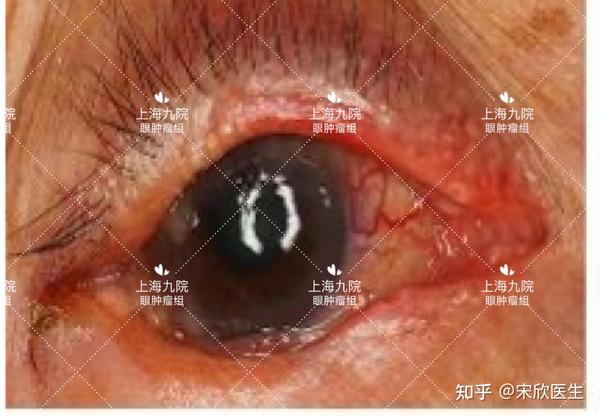 警惕!有可能是皮脂腺癌