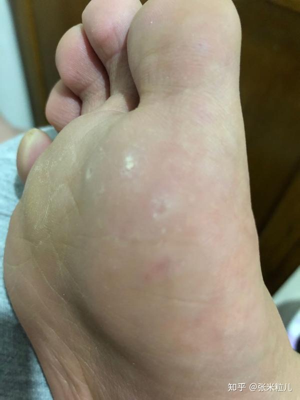 跖疣自愈经验分享