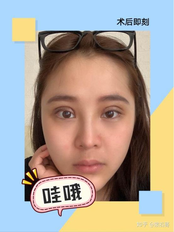 成都双眼皮哪里做比较好?术后即刻分享