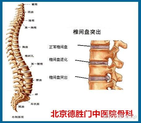 北京治疗腰椎间盘突出骨科医院-造成腰椎间盘突出的原因是什么