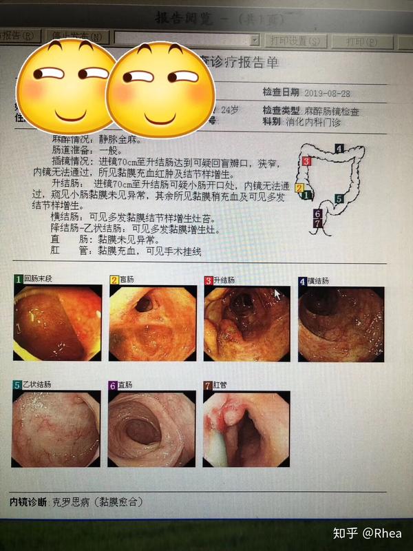 艾伯维apt-494服药三个月后的肠镜检查克罗恩