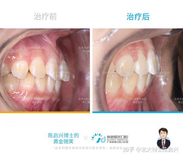 第一期是功能矫正阶段,戴activitor (肌激动器)引导下颌骨向前生长