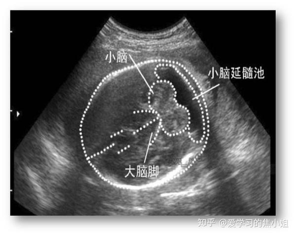 小脑延髓池扩大:直径10mm以上.持续增宽会导致脑积水.