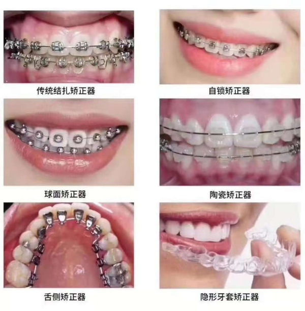 广州牙齿矫正/正畸哪家医院好?牙齿正畸需要多少钱?