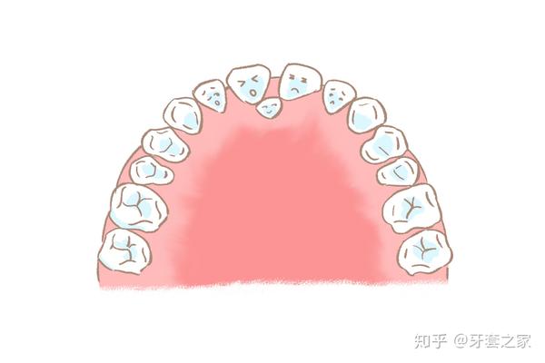 那些额外牙呢,他们又叫多生牙由于萌出后占据了间隙而导致牙列拥挤