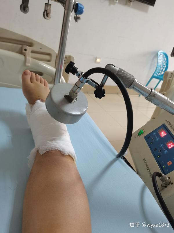 脚踝骨折及恢复过程记录