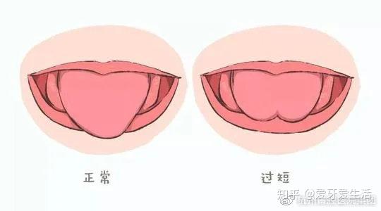 常常有父母发现自家的宝宝说话不清楚,舌头不能自然活动,心里头那个