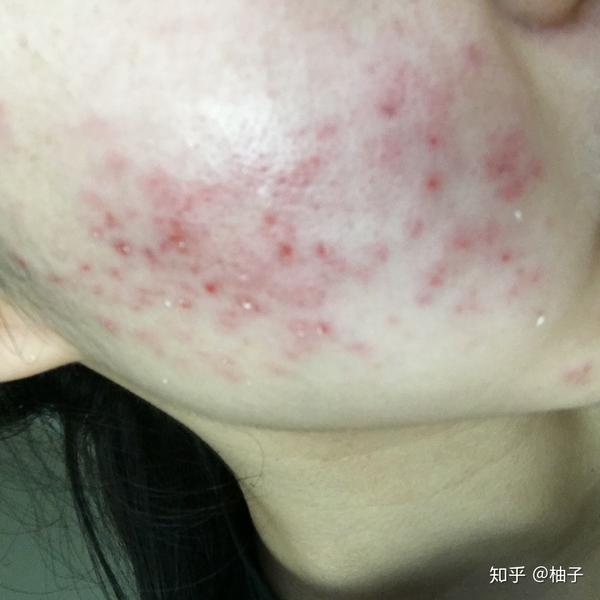 右脸颊,针清之前,没什么明显痘痘,医生一看,说有很多粉刺