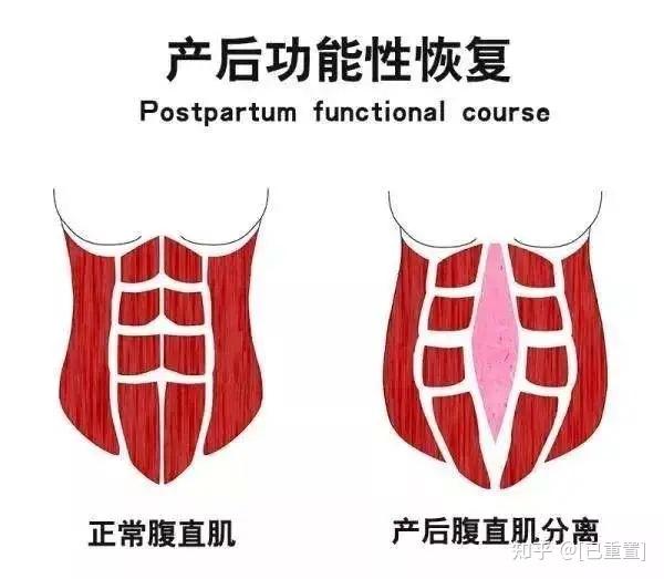 搞定腹直肌分离告别肉松大肚腩