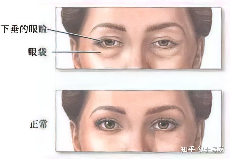 哪些行为会导致上眼皮松弛?
