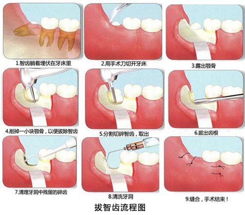 拔智齿后嘴里恶臭是什么情况?