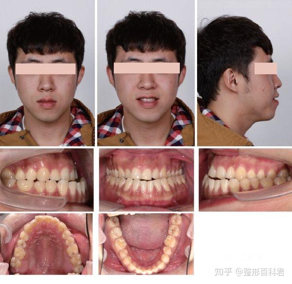 说出来 1:父母或隔代遗传所致的下颌骨发育过度或(和)上颌骨发育不足