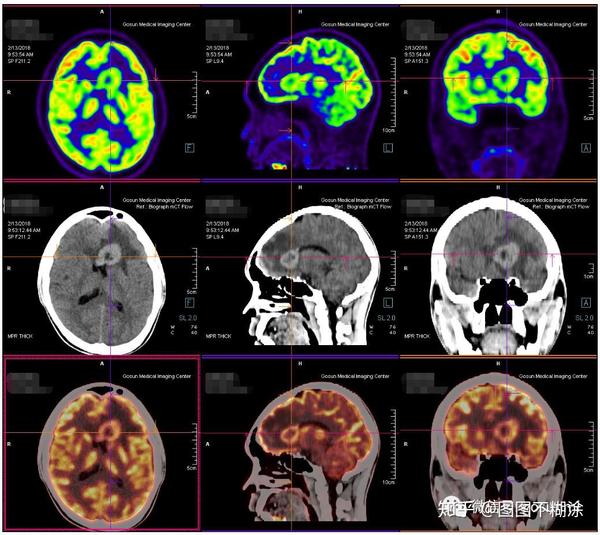 【pet/ct专辑】筛查肿瘤的神器——pet/ct