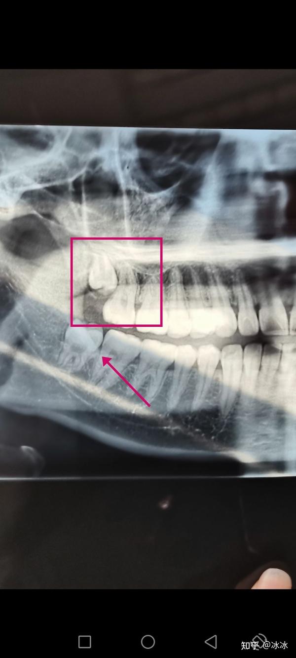 拔智齿拍片,发现一颗长在牙龈里面(方框里的那颗)但是这颗智齿不痛