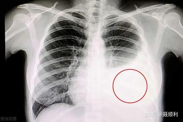 胸腔积液的x光胸片