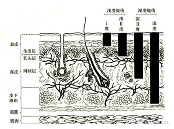 烧伤的三度四分法.图片来自网络