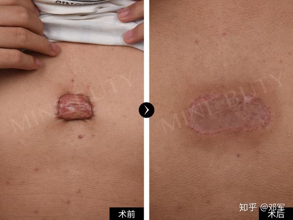 持续增大,我们分类为疤痕疙瘩 手术方式为疤痕切除 植皮 抗瘢痕增生
