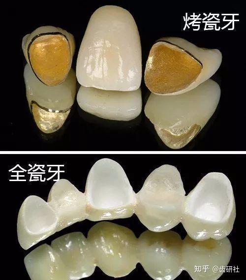 全瓷冠和烤瓷冠的区别看了就能做出选择