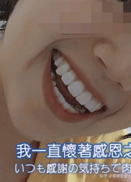 成人正畸后牙齿松动的真凶———骨开窗