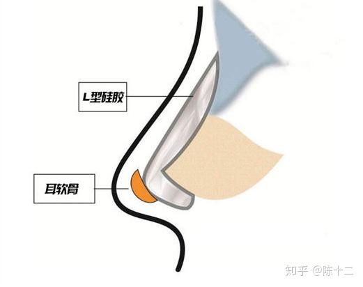 所以,现在很少有医生会给你用l型假体隆鼻了, 一般会用 i型假体垫鼻