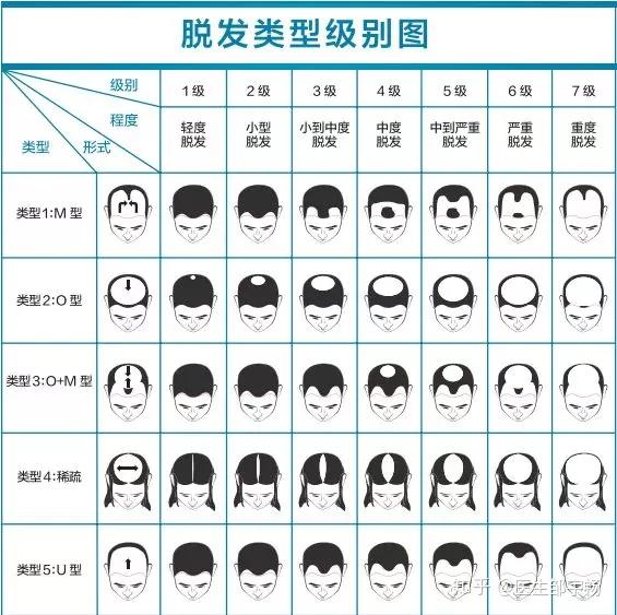 怎样判断自己是不是雄激素性脱发?