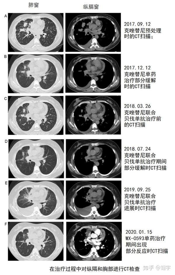 lungcancer案例特殊的alk基因融合让非小细胞肺癌患者实现长期生存