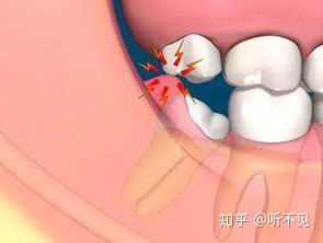 极光口腔智齿冠周炎一种难以言喻的疼痛