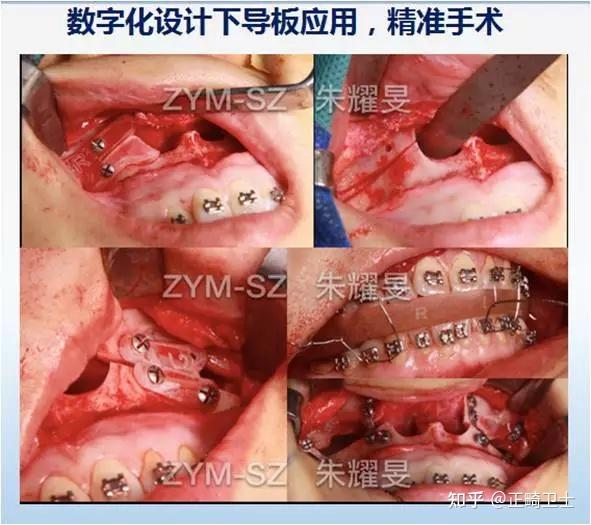 朱耀旻博士数字化正颌手术案例分享