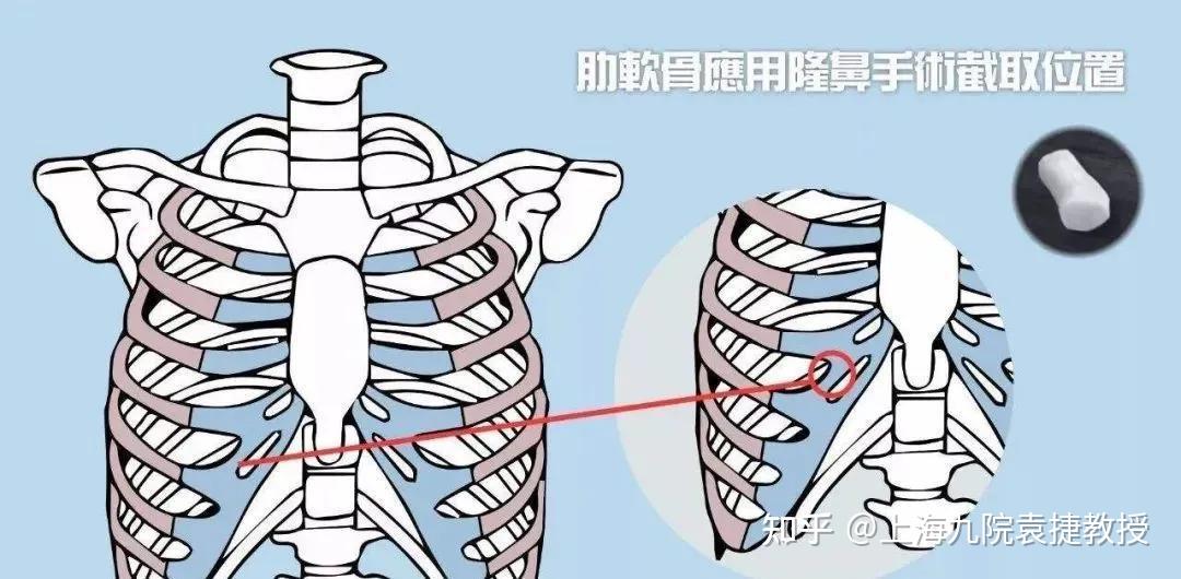 为什么肋软骨钙化严重就不能隆鼻