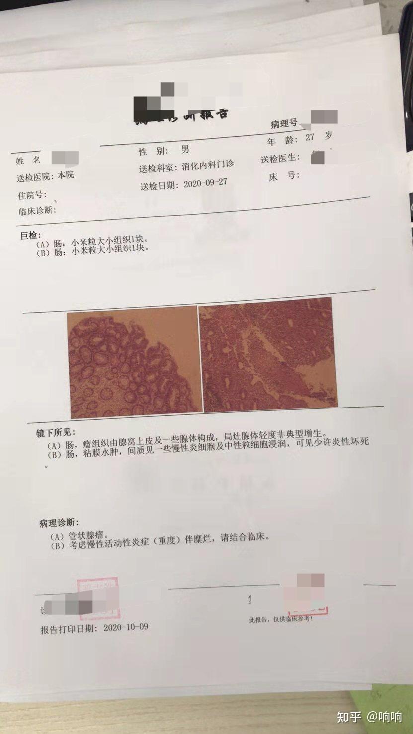 男朋友28岁溃疡性结肠炎后的200天