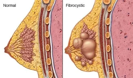 小的乳腺结节会随着月经周期发生一些微小的变化,大小变化一般在几