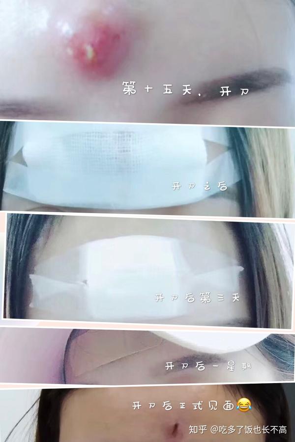 屁股上长个火疖子是什么感受 ?