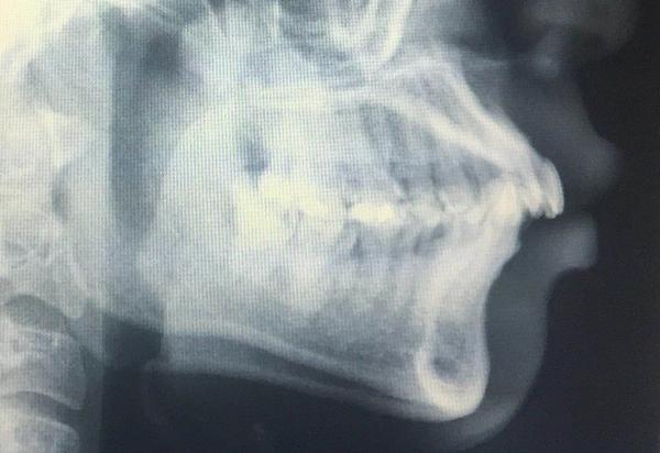 第一次上门问诊,采模型,拍x光片,本来只是觉得自己下门牙有点龅牙