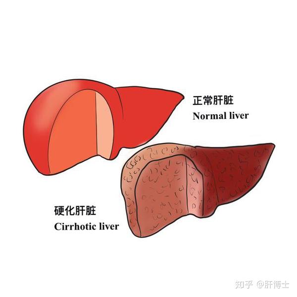 我国肝硬化的病因以乙型肝炎病毒感染者为主,目前酒精性,脂肪性,药物