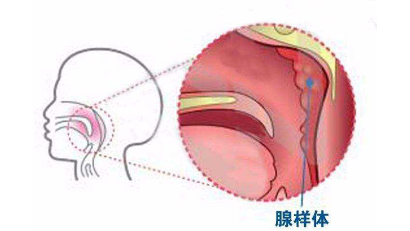 李健东儿童腺样体肥大可以不手术吗