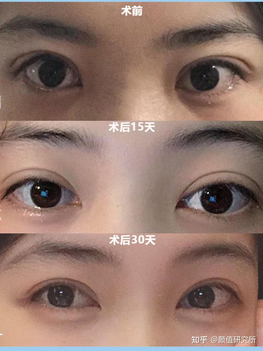 双眼皮内眼角三次眼修复历程,国内医生大佬测评靳小雷 韩勋 韩新鸣