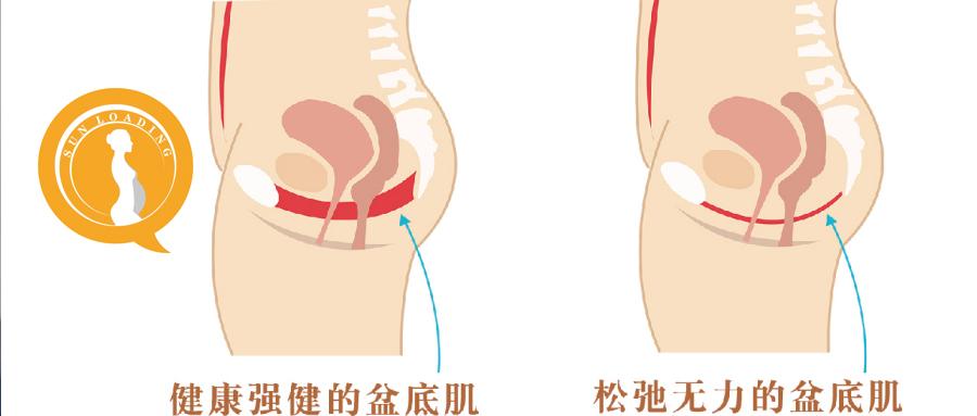 产后3年了做盆底肌骨盆恢复还有用吗