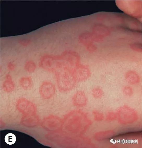 多形红斑最常见被单纯疱疹病毒诱发,参考1